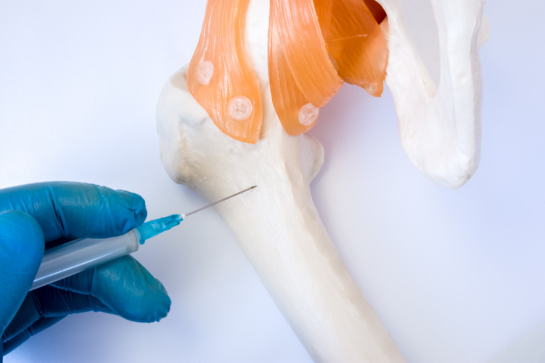 Un hidrogel impreso con láser podría revolucionar el tratamiento de fracturas óseas