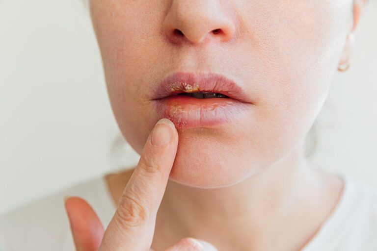 FDA aprueba un nuevo fármaco contra el herpes resistente: así funciona el pritelivir